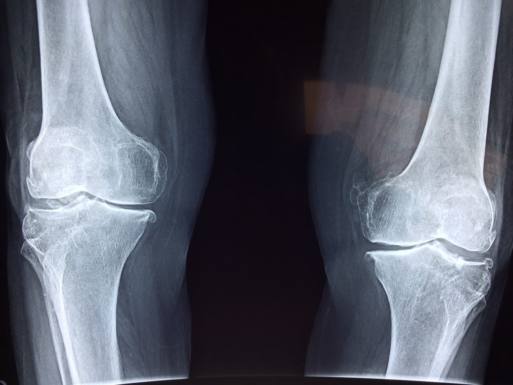 knee xray. orthopaedic negligence claims.